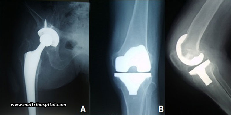 Cementless Knee Replacement Surgery – A Safer And Reliable Alternative